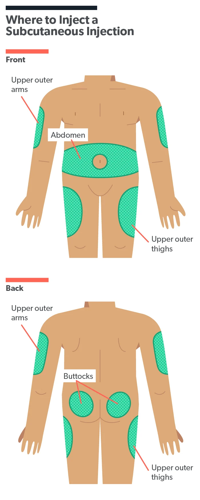 Ett diagram som visar lämpliga platser på människokroppen för subkutana injektioner.